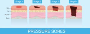 Management of Pressure Ulcers in Elderly Patients